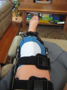 Bionic knee