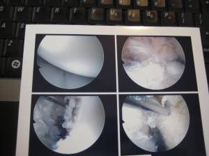 Pictures from the knee scope