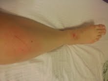 Are you getting tired of pictures of my leg injuries?