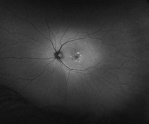 A black and white picture of the inside of an eye with the optic nerve visible and a white circle around the fovea